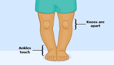 बचपन से टेढ़े पैरों का ईलाज