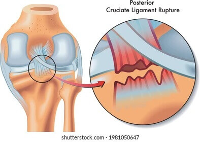 दुरबीन द्वारा घुटने एवं कंधे के टुटे लिगामेंट का इलाज